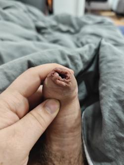 epidermito picture